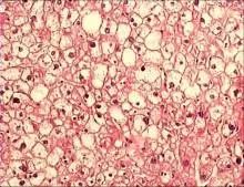 ballooning-degeneration Ballooning Degeneration and Reticular Degeneration