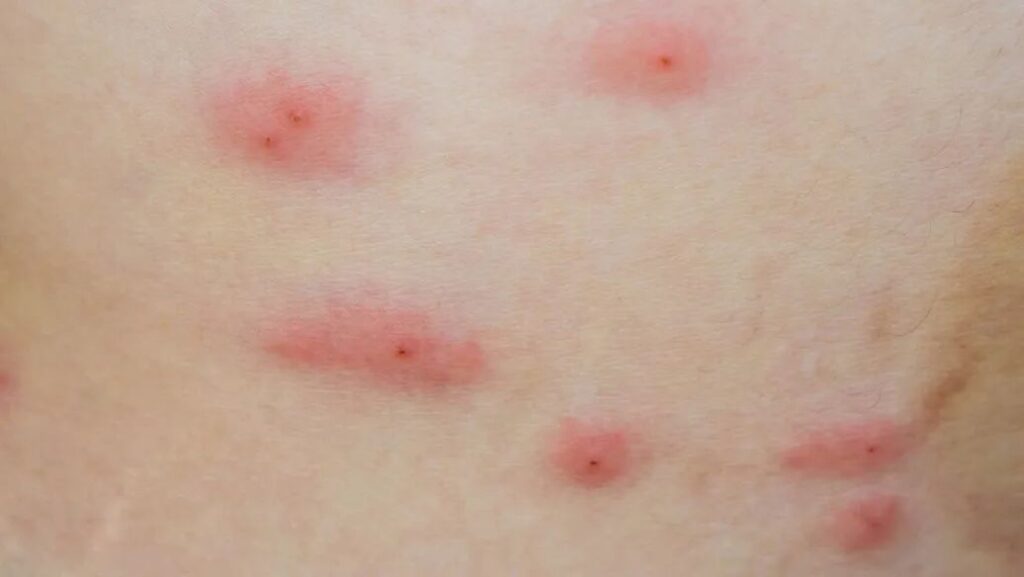 skin-with-herpes skin with herpes